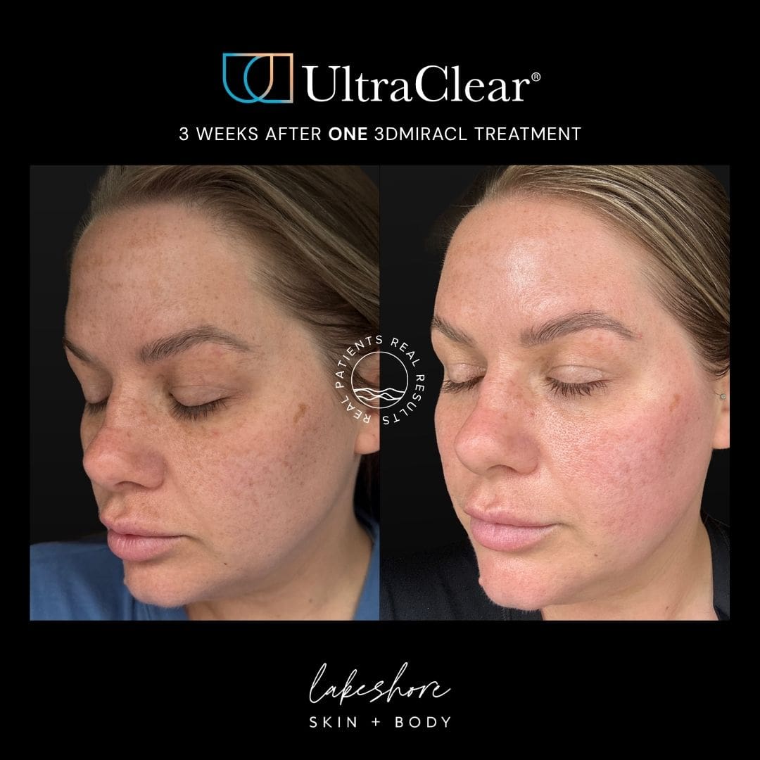 Before and after: 3 Weeks After one 3DMIRACL treatment at Lakeshore Skin + Body