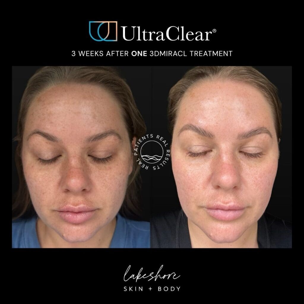Before and after: 3 Weeks After one 3DMIRACL treatment at Lakeshore Skin + Body