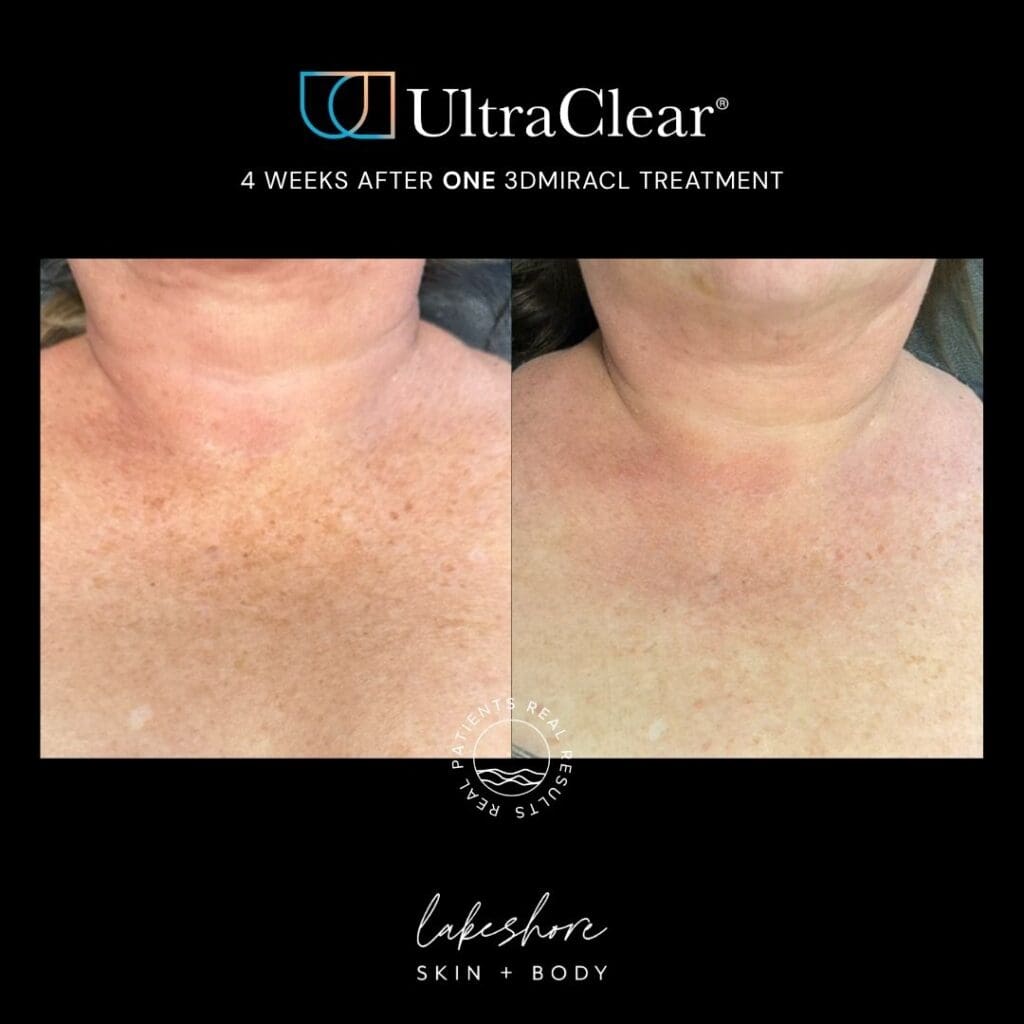 Before and after: 4 Weeks After one 3DMIRACL treatment at Lakeshore Skin + Body
