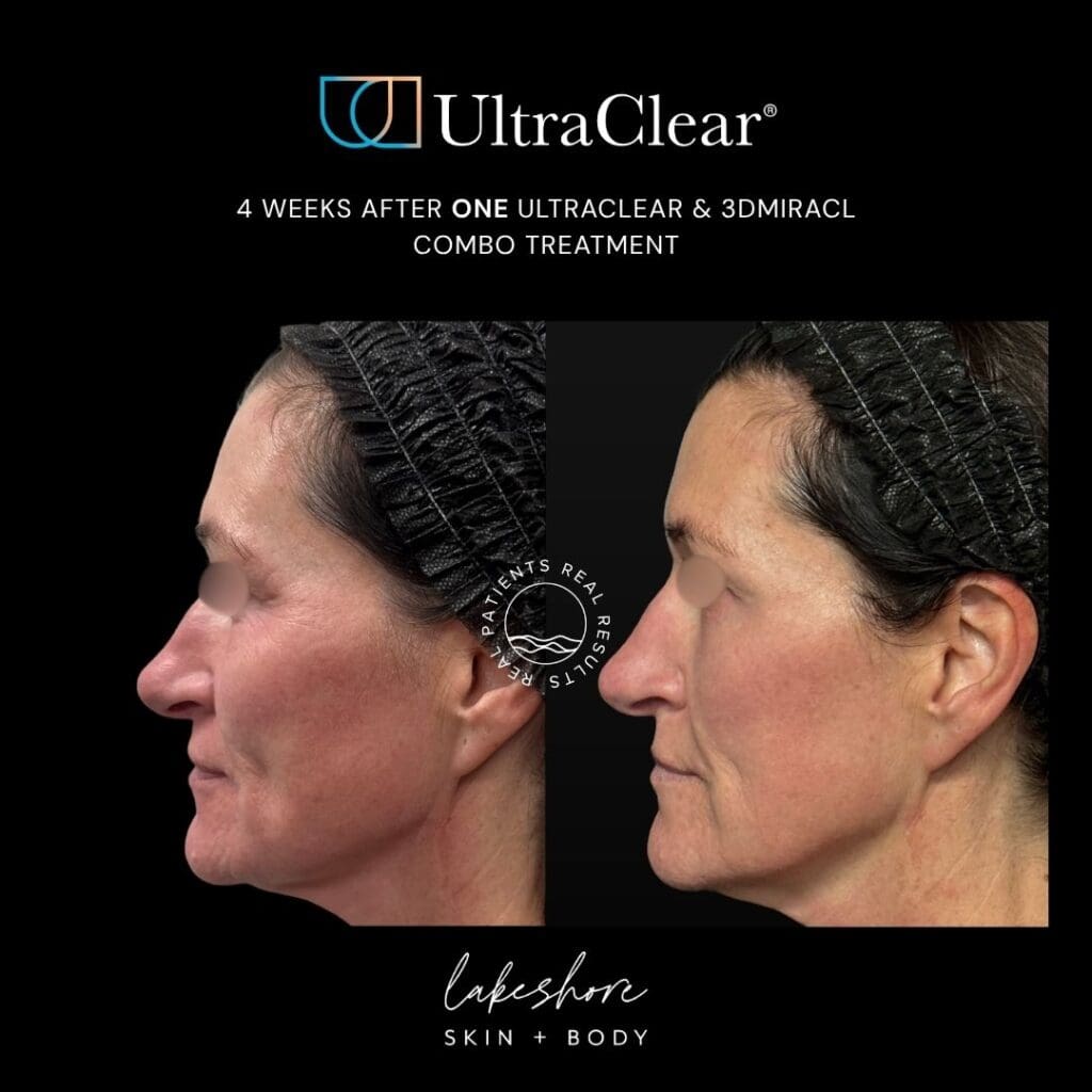 Before and after: 3 Weeks After one UltraClear treatment at Lakeshore Skin + Body